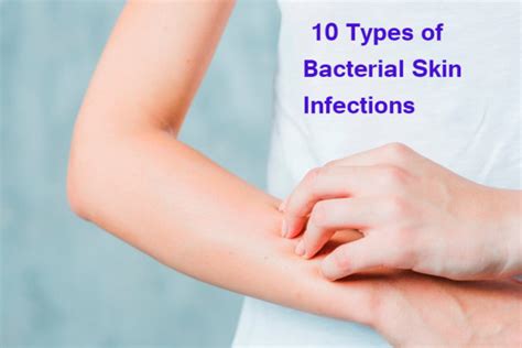 10 Types Of Bacterial Skin Infections Yabibo