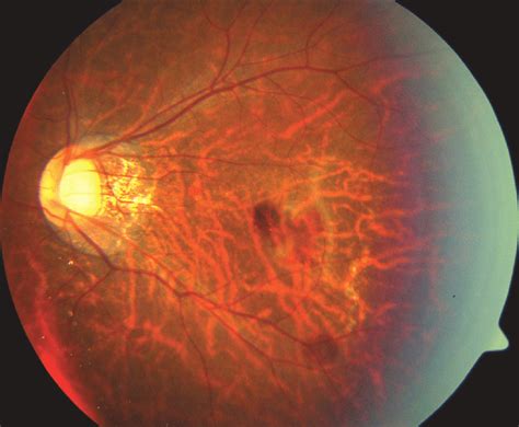 Myopic Fundus With Subretinal Haemorrhages At The Fovea And Along The