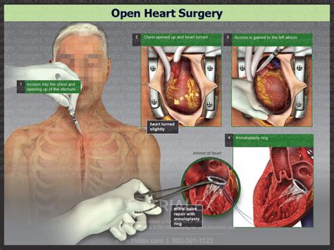 Open Heart Surgery Trial Exhibits Inc