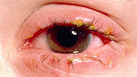 Dry Skin Around Eyes Or Eyelids Causes And Treatments