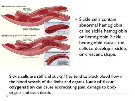 Ppt Sickle Cell Anemia Powerpoint Presentation Id4063359