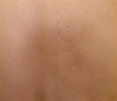 Cutaneous Amyloidosis Pictures Photos