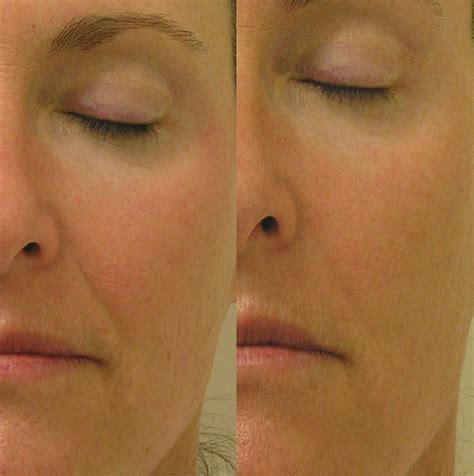 Hydrafacial Md In New Jersey Soma Skin And Laser