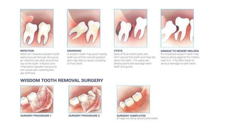 Stonehill Dental Warning Signs Of Impacted Wisdom Teeth