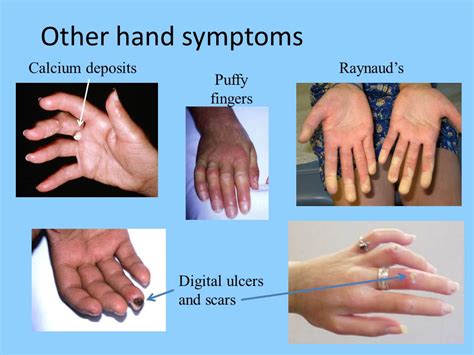 Systemic Scleroderma Hands