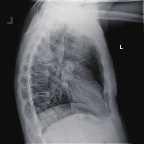 Anatomy Of Chest X Ray