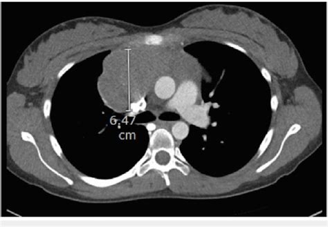 Ct Chest Showing An Anterior Mediastinal Mass Measuring 647 Cm