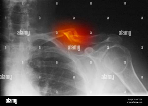Collarbone Xray Hi Res Stock Photography And Images Alamy