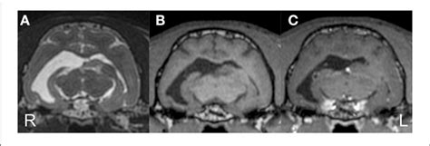 Preoperative Structural Mri Transverse T2 Weighted A T1 Weighted