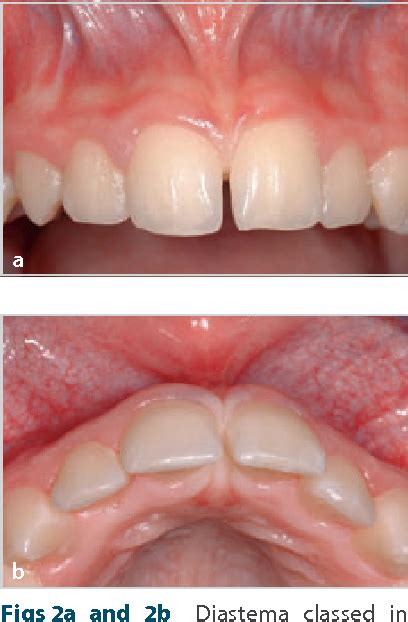 Figure 2 From Does The Maxillary Midline Diastema Close After