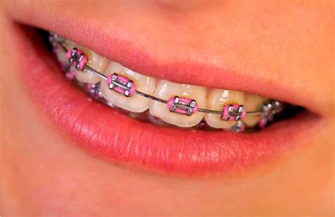 Pin By Yurutzi ️ On Dd Pink Braces Braces Teeth Colors Cute Braces Colors