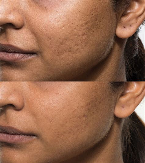 Improve Or Eliminate Acne Scars With No Downtime Look Better This