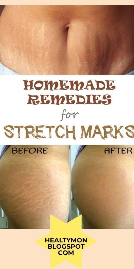 Home Remedies For Stretch Marks How To Clear Stretch Marks How To Get