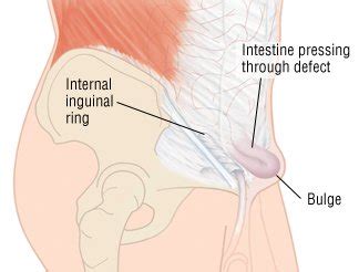Inguinal Hernia Guide Causes Symptoms And Treatment Options