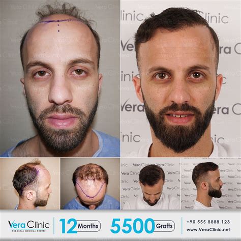 Vera Clinic Hair Transplant In Turkey Hair Restoration Surgery