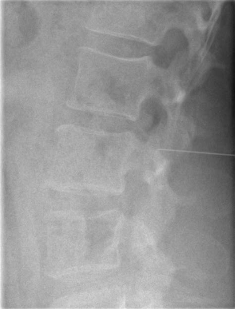 Fluoroscopic Guided Lumbar Puncture Image