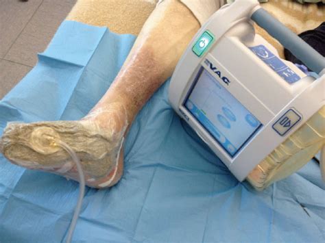 Diabetic Foot Ulcer Treated By Negative Pressure Wound Therapy My Xxx Hot Girl