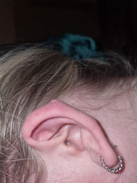 Another Keloid Or Irritation Bump Post Rpiercing