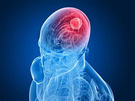 Brain Tumor Symptoms Everything You Need To Know