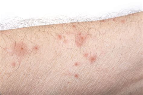 Infections Infestations And Bites Dermatology Australasia