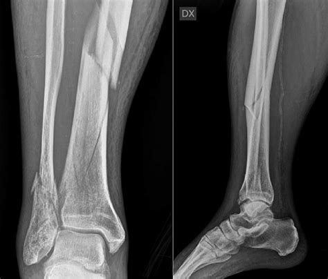 Tibial Distal Fracture Ao 42 B1 With Irradiation Of The Fracture Line
