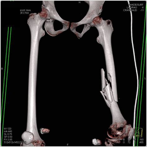 Cta With Intact Vessels With Right Femur Fracture Vascular Case
