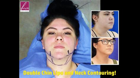Double Chin Liposuction With Neck Contouring Wide Awake Local