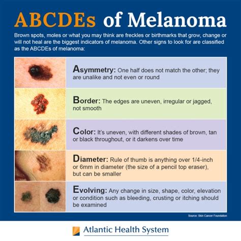 How To Spot Melanoma The Early Warning Signs Of Skin Cancer