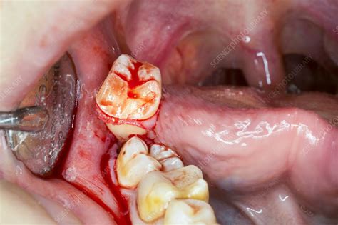 Wisdom Tooth Extraction Stock Image C0400707 Science Photo Library