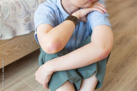 Psoriasis Of A Young Girl On Her Elbows Sitting On The Bedroom Floor