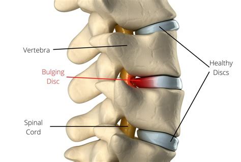 How To Heal A Bulging Disc Naturally Spinal Backrack