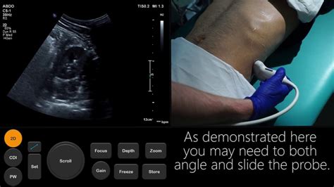 Ultrasound Tutorial Kidney Bladder Urinary Tract Radiology Nation YouTube