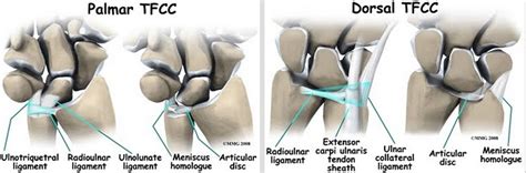 Triangular Fibrocartilage Complex Tfcc Injury Hand Orthobullets