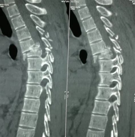 Spine Injuries Xrays And Photographs Bone And Spine