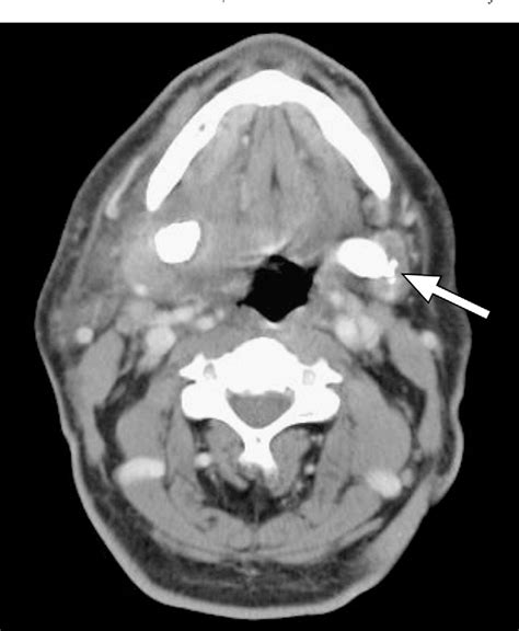 Figure 1 From Bilateral Giant Submandibular Sialoliths And The Role For