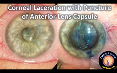Another Corneal Laceration With Traumatic Cataract Cataract Coach