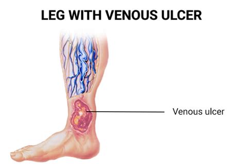 Venous Stasis Ulcer Vein Endovascular Medical Care