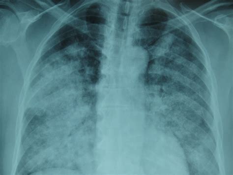 Diffuse Alveolar Hemorrhage Syndrome