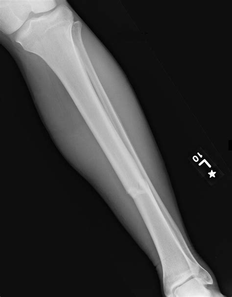 Roentgen Ray Reader Isolated Tibial Diaphysis Fractures