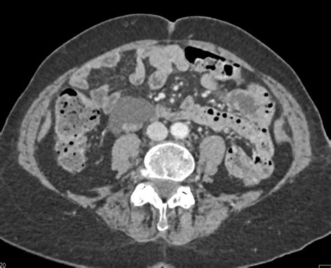 Mesenteric Cyst Gastrointestinal Case Studies Ctisus Ct Scanning