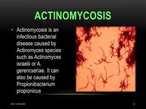 Ppt Actinomycosis Powerpoint Presentation Free Download Id2152211