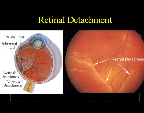 Retinal Detachmenttypescausessymptoms And Treatment How To Relief