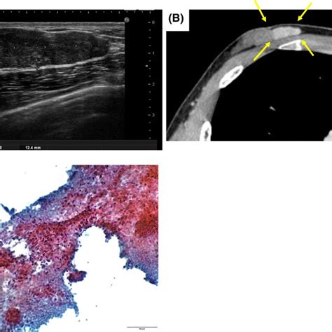 A Breast Ultrasonography Shows An Oval‐shaped Hypoechoic Mass With A
