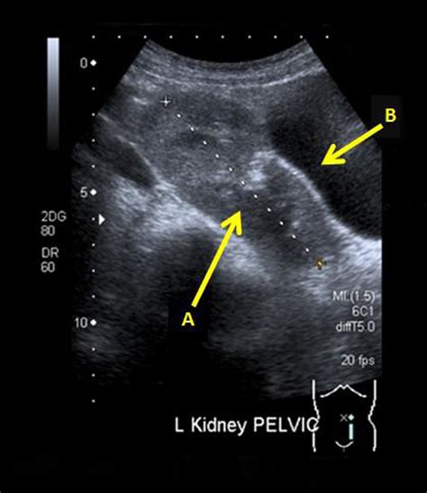 Pelvic Renal Ectopia An Incidental Finding Bmj Case Reports