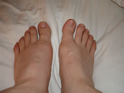 what causes swollen feet apps directories