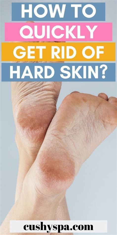 How To Get Rid Of Dead Skin On Feet Step By Step Guide Dead Skin On Feet Dry Skin On Feet