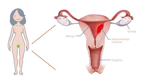Endometrial Cancer Guzipbio