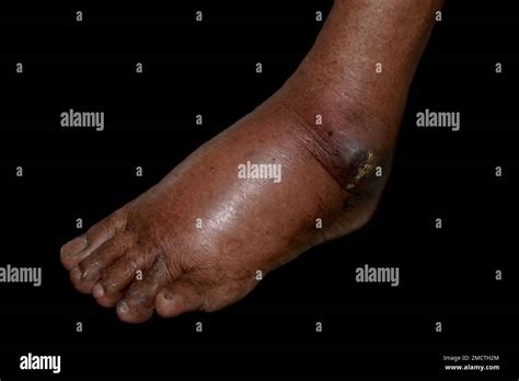 Unilateral Edema Of Upper Limbs Swollen Leg And Foot Of Asian Man