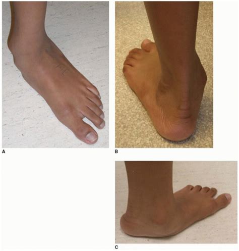 Calcaneal Lengthening Osteotomy Musculoskeletal Key