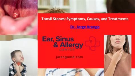 Ppt Tonsil Stones Symptoms Causes And Treatments Dr Jorge Arango
